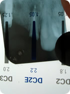 Instalação de Pino de Fibra 3