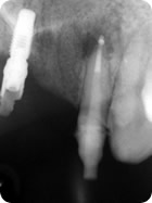 Instalação de Pino de Fibra 4