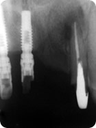 Remoção de Núcleo 1