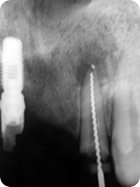 Remoção de Núcleo 3